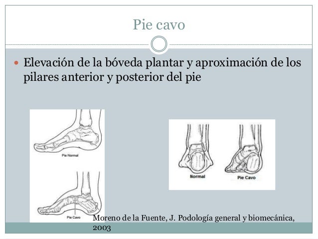 biomecanica del pie cavo